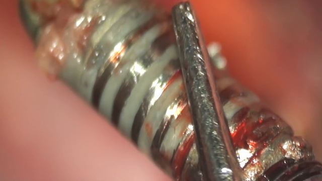 удаление имплантатов смотреть онлайн