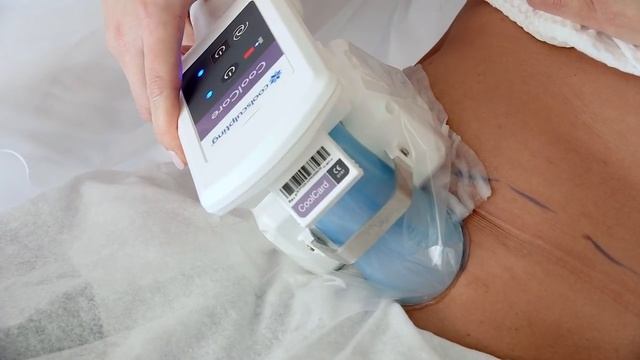 Как убрать живот и бока за короткий срок. Криолиполиз - коррекция фигуры на аппарате Зелтик смотреть онлайн