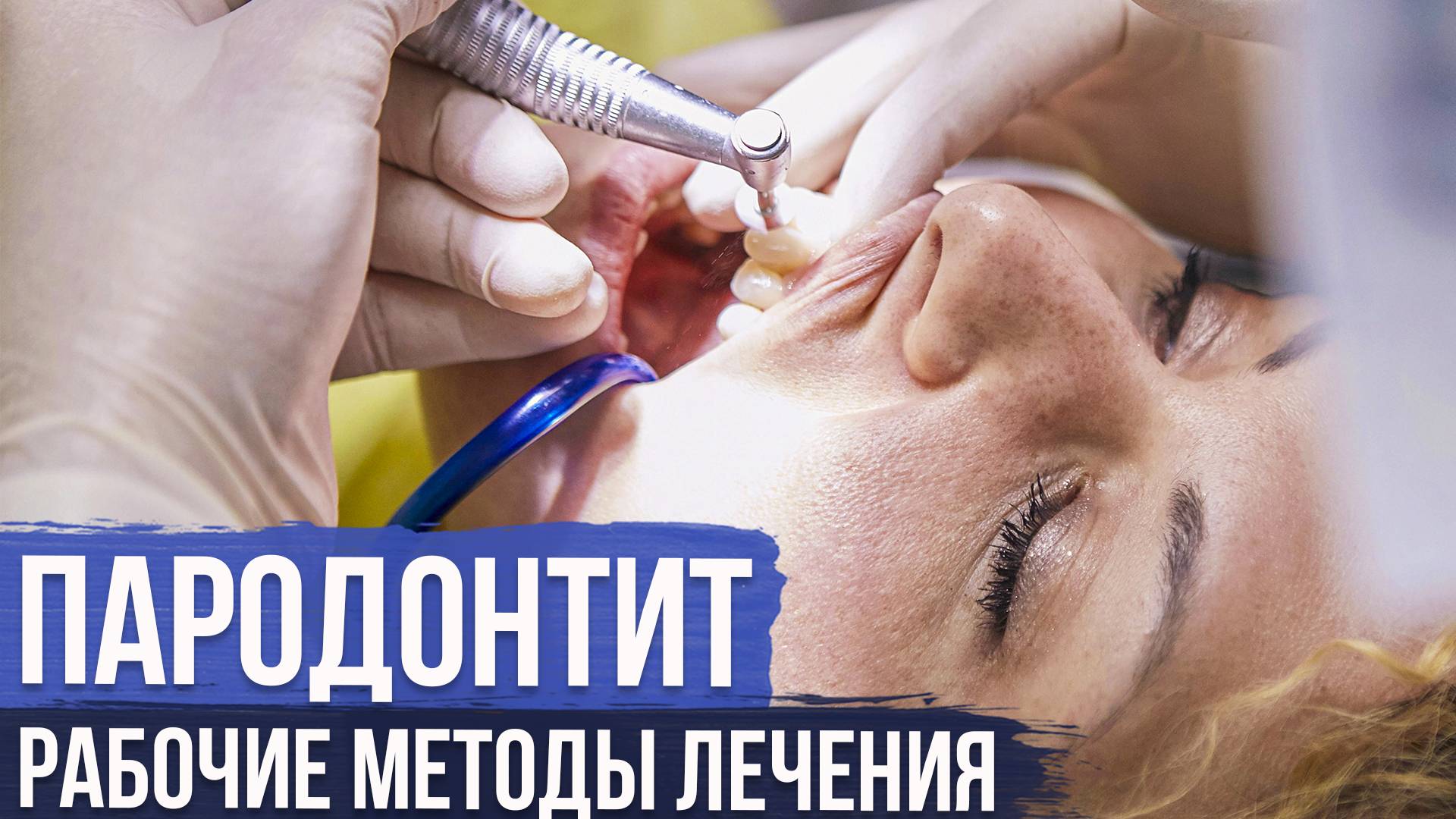 Все О Лечении Пародонтита: Как Предотвратить Потерю Зубов