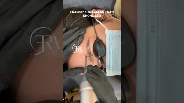 ERAlaser XOÁ XĂM AN TOÀN KHÔNG SẸO #phươngđỗ #saigon #eralaser #laser #xoaxam #quan10 #xoáchânmàyđỏ смотреть онлайн