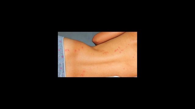 Как лечить укусы клопов? смотреть онлайн