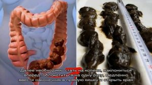 Постановка клизмы при геморрое в домашних условиях