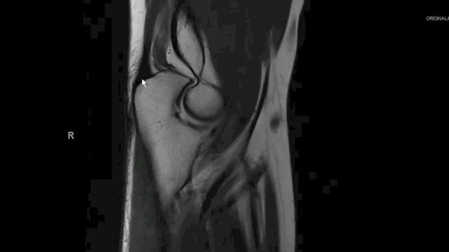 MRI Elbow Anatomy 1920 x 1080 смотреть онлайн