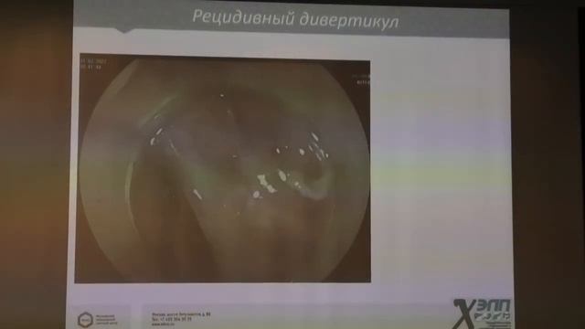 01 Шишин КВ Дивертикул Ценкера Ахалазия Кардии смотреть онлайн