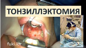 Тонзиллэктомия под наркозом (удаление небных миндалин). лор-хирург к.м.н. Фуки Е.М.
