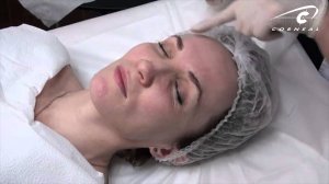 Пилинг Джесснера за 30 секунд