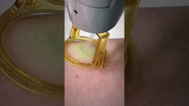 Удаление нежелательных волос александритовым лазером Candela . Лазерная эпиляция
