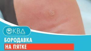 Бородавка на пятке. Клинический случай №121