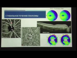 Нарушение хориоидальной гемодинамики - причина или следствие глаукомной оптической нейропатии