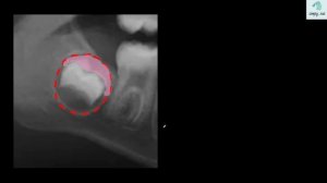 Common mandibular cysts (lucent mandibular lesions)