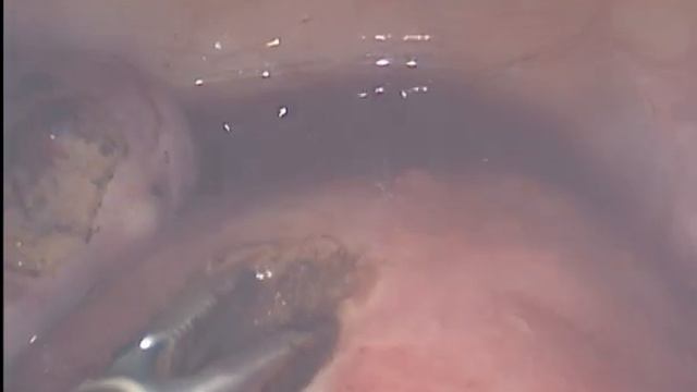 Laparoscopic Uterine cyst excision / Лапароскопическое иссечение кисты матки смотреть онлайн