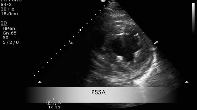 Трепетание предсердий и передний ИМ смотреть онлайн