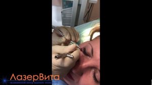 Удаление родинки на лице лазером