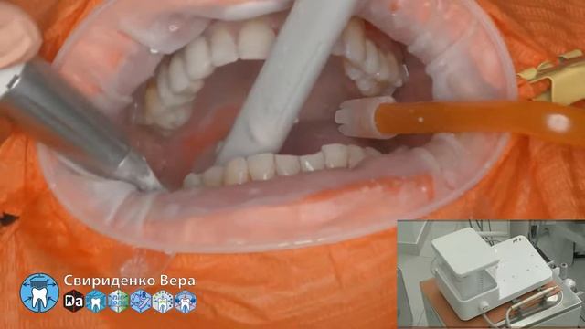 Professional oral hygiene -case 017 Acteon DTE Dentsply Coxo Floweis 3M KerrHawe (FHD multistream)