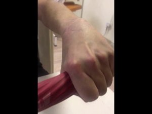 Реабилитация после перелома ладьевидной кости