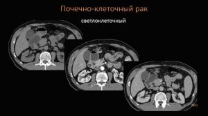 КТ Абдоминальная визуализация 16 Лекция «КТ почек и МВС» Лектор Пихута Д А 3