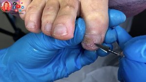 Онихолизис ногтей / Отдавила ноготь на ноге