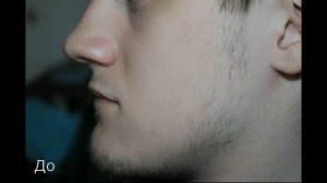 Миноксидил | 1.5 месяца применения | Результат