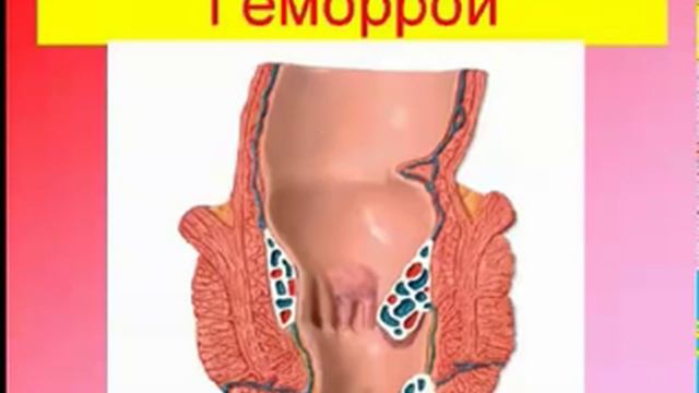 Как избавиться от варикозной болезни? Эндорфинотерапия.