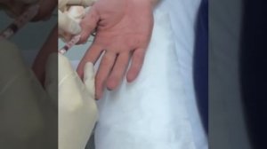 Лечение потливости рук ботоксом