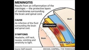 Fungal Meningitis