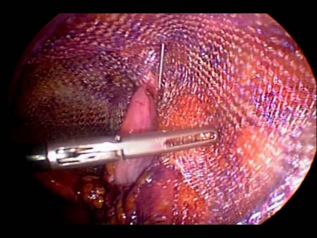 лапароскопическая ТАПП операция при паховой грыже у женщин смотреть онлайн