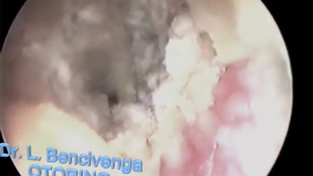 Otorino Ostia Ladispoli (I Funghi dell'orecchio-le OTOMICOSI) смотреть онлайн