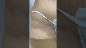 Результат через год Абдоминопластика с укреплением мышц и липосакция