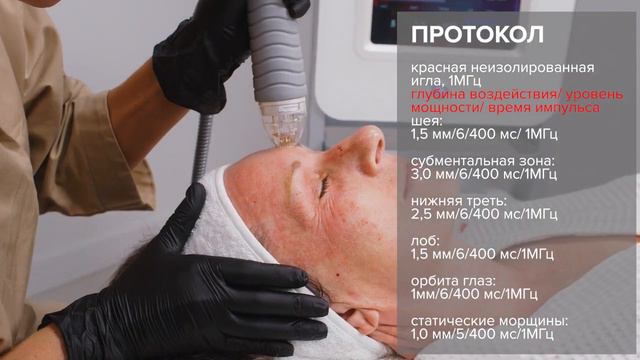 Омоложение на аппарате VIVACE. Кейс: Людмила, 53 года, мышечный-мелкоморщинистый тип старения смотреть онлайн