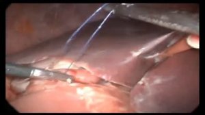 Лапароскопическое ушивание перфоративной язвы 12пк