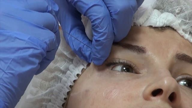 Из брови к виску канюлей смотреть онлайн