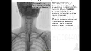 РЕНТГЕНОСКОПИЯ ПИЩЕВОДА