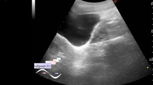 Детское УЗИ органов малого таза - Апоплексия яичника