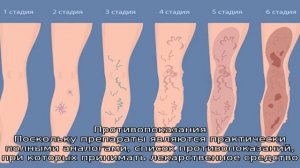 Что лучше — Венарус или Флебодиа?