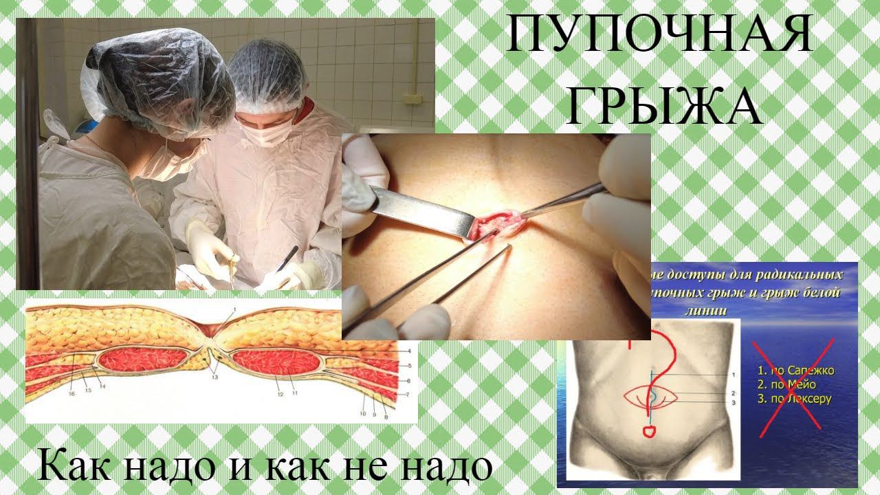 Пупочная грыжа. Как надо и как не надо.