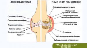 МИОФАСЦИАЛЬНЫЙ СИНДРОМ