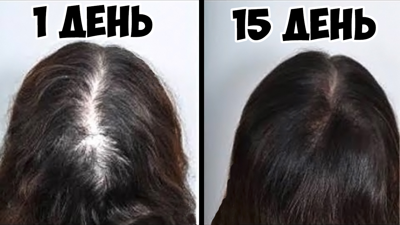 Волосы растут как бешеные - сильнейшая маска от выпадения волос, реально работает