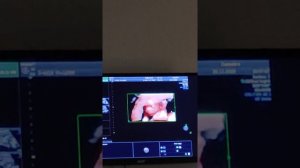 УЗИ Срок 16 недель. 30.11.2020