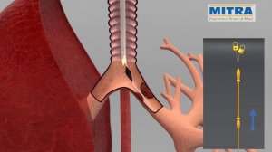 Tracheobronchial "Y"  stent, MITRA OTTOMED ENDOSCOPY, Interventional Pulmonology