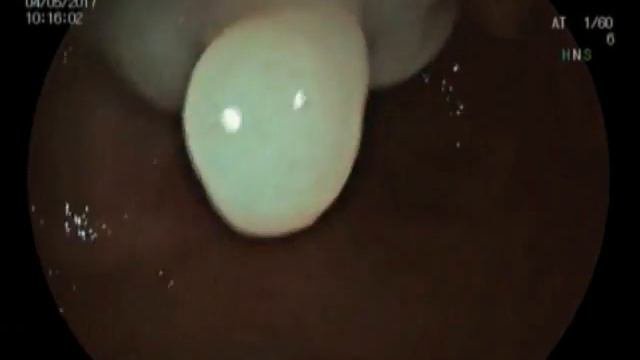 Diagnostic And Treatment GI Endoscopy