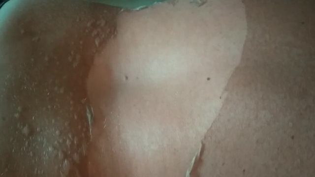 Это жесть!!! Снимают кожу с моей спины! Обгорел на солнце.