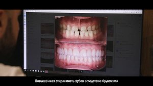 Повышенная стираемость зубов вследствие бруксизма