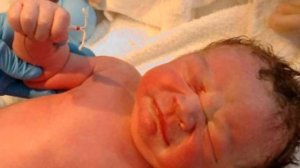 Малыш родился со спиралью в руке! Он обошёл все преграды сам!