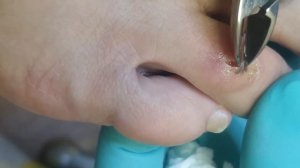 гнойный экссудат