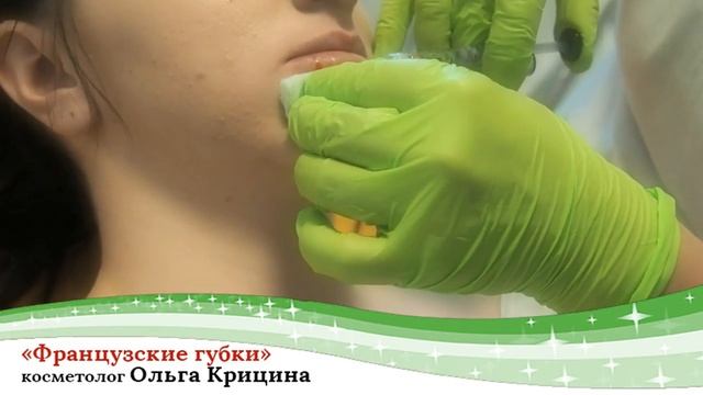 Контурная пластика губ "французские губки". Я за натуральность!