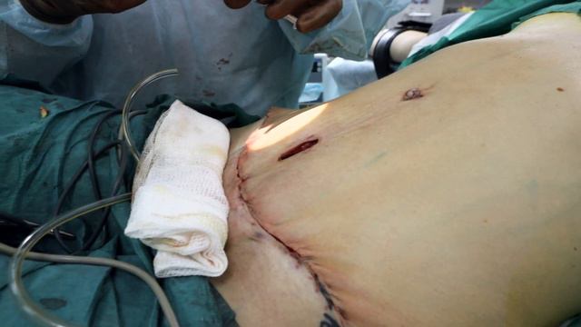 Абдоминопластика (пластика живота): вертикальный рубец