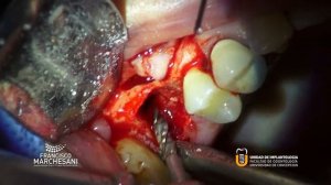 MAXILLARY SINUS LIFT IN A FRESH EXTRATION SOCKET