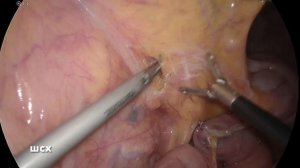 Лапароскопическая резекция желудка