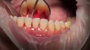 Лечение пародонтита лазером Picasso