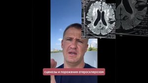 Причины снижения памяти и появления очагов глиоза: атеросклероз и гидроцефалия
